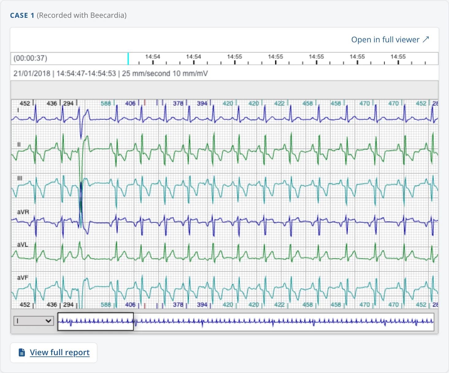 A case embedded in the ventricular premature complexes learning guide, with the ECG shown in the Beecardia viewer